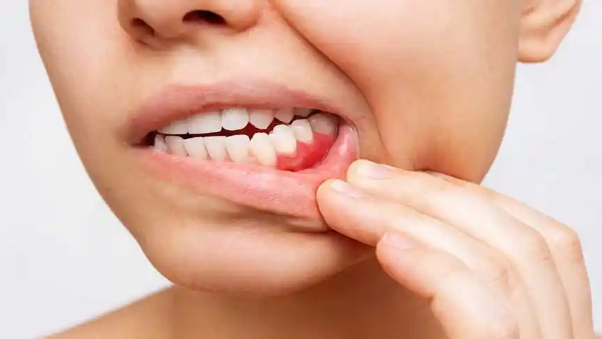 Diş Eti Çekilmesi Tedavisi-featured-image-linee