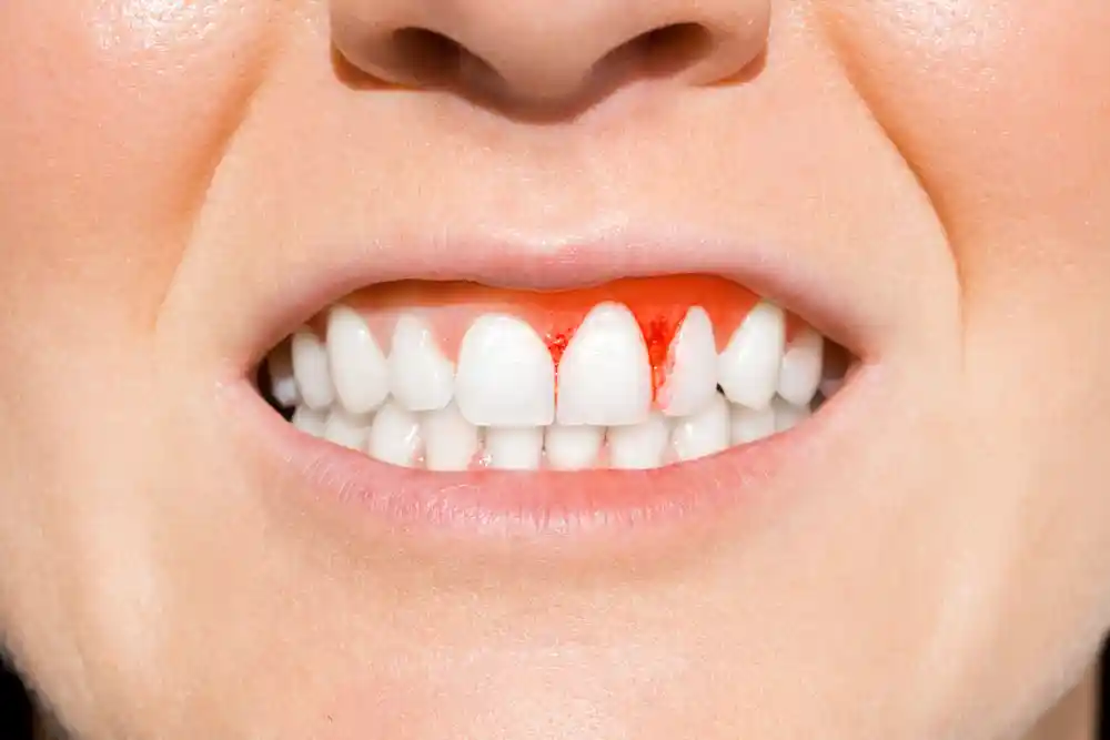Diş Eti Kanaması Hizmeti-featured-image-linee
