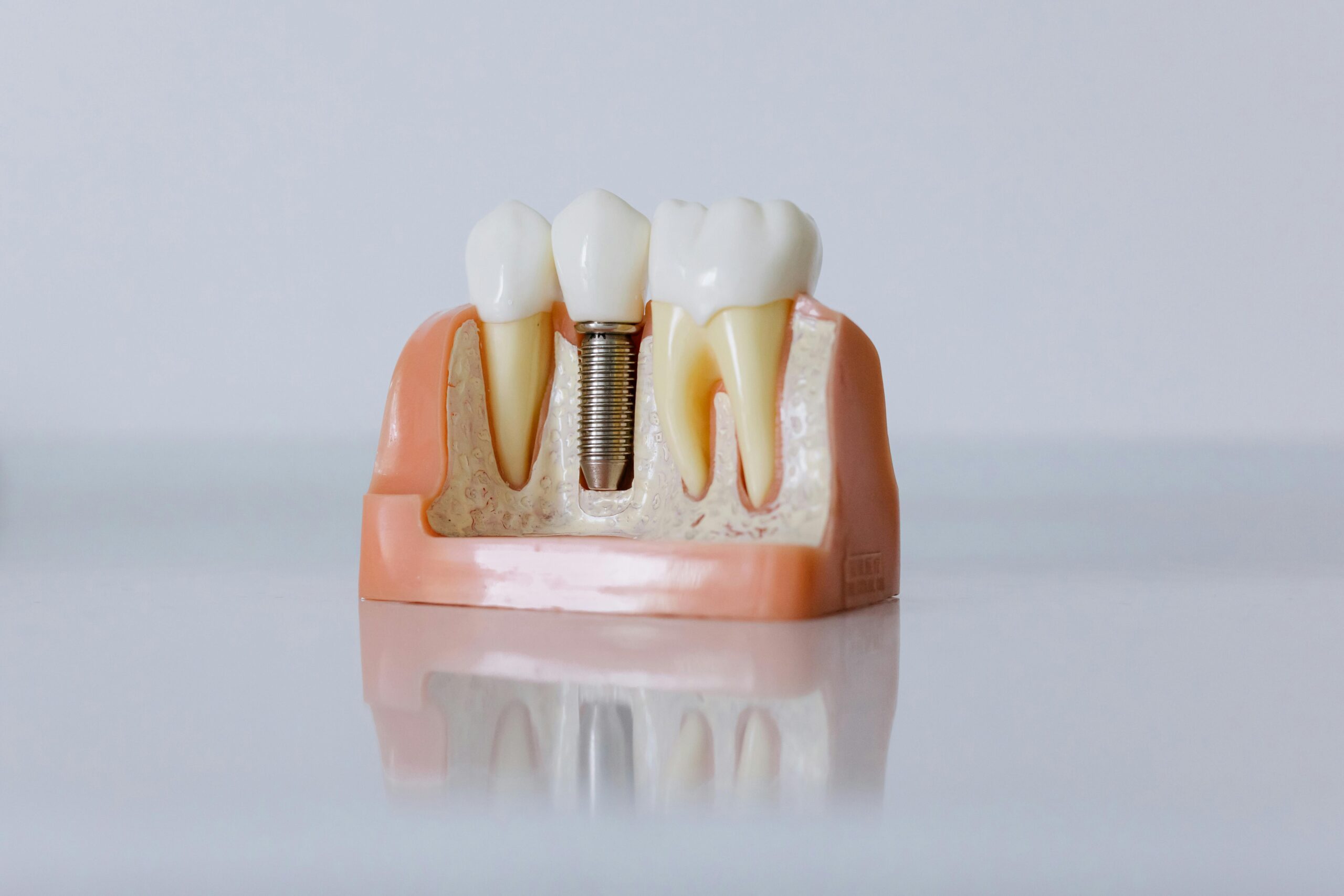 Küçük İmplantlar, Büyük Konfor: Mini Dental İmplantlarla Yeniden Gülümseme