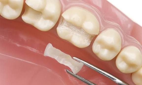 restoratif tedavilerle