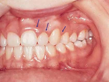 dişeti İltihabı (gingivitis)