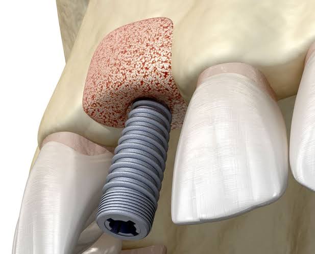 dental greft tedavisi