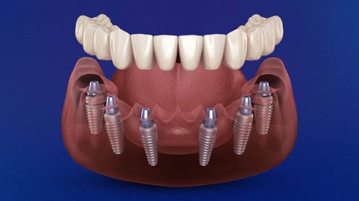 dental İmplant tedavisi