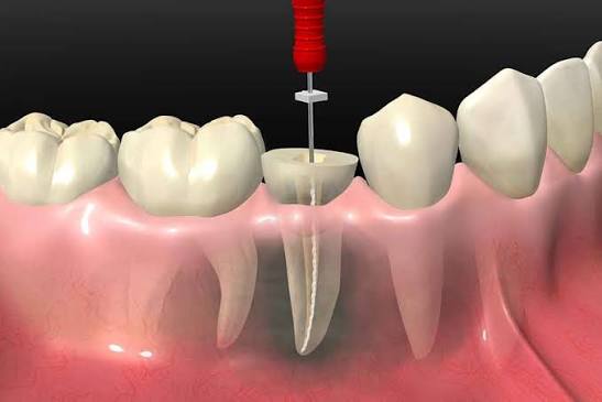 endodonti
