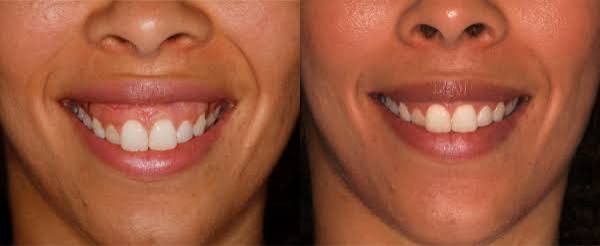 gummy smile tedavisi