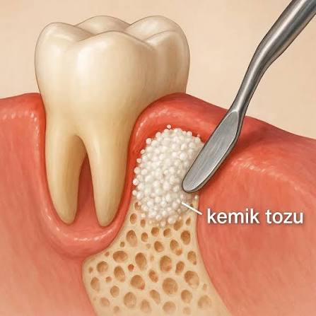 İmplant Öncesi kemik grefti
