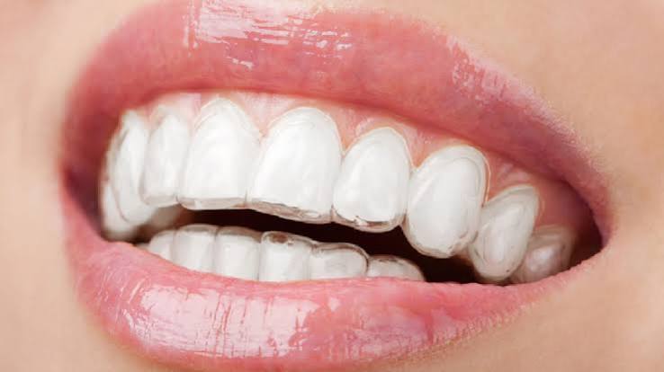 İnvisalign benzeri plak