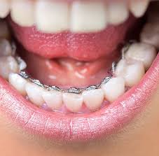 lingual ortodonti s