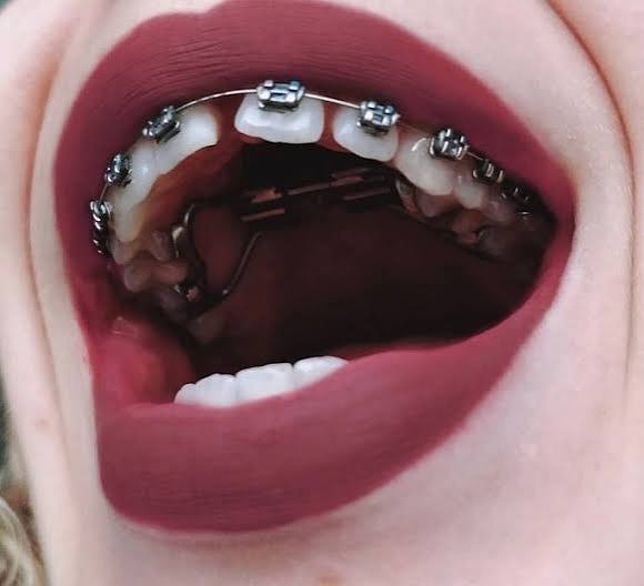metal diş teli