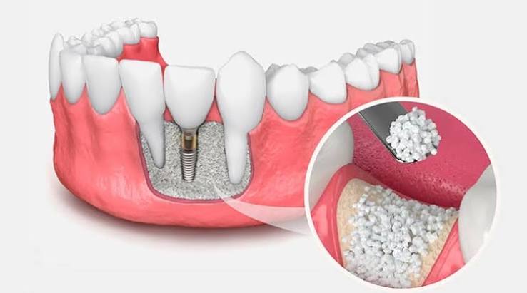periodontal greft tedavisi