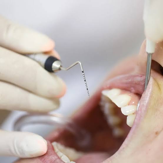 periodontal tedavi
