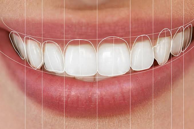 smile design