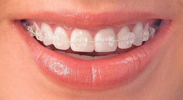 ortodonti nedir hangi diş ve Çene problemleri İçin değerlendirilebilir